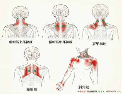首肩に関係する筋肉とトリガーポイント