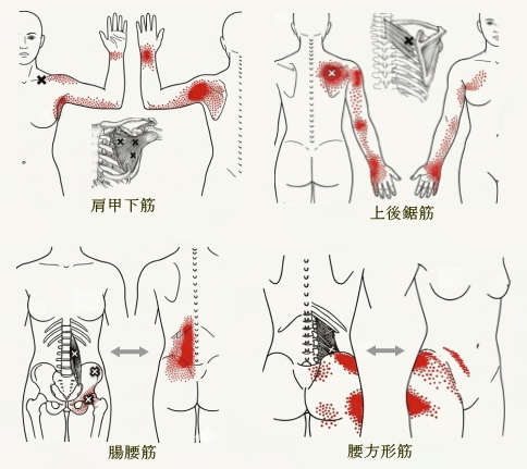 肩こりや腰痛の原因となる筋肉のトリガーポイント
