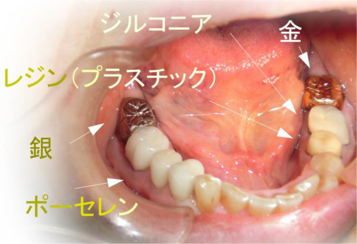 大きな虫歯1