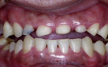 酸蝕歯について 酸蝕歯の治療なら 歯を削らずに治す西村歯科医院 酸蝕歯について 酸蝕歯の治療なら 歯を削らずに治す西村歯科医院