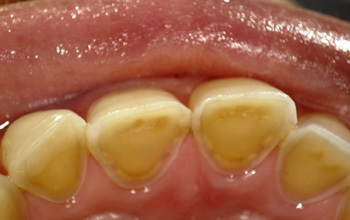 酸蝕歯について 酸蝕歯の治療なら 歯を削らずに治す西村歯科医院 酸蝕歯について 酸蝕歯の治療なら 歯を削らずに治す西村歯科医院