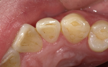 酸蝕歯について 酸蝕歯の治療なら 歯を削らずに治す西村歯科医院 酸蝕歯について 酸蝕歯の治療なら 歯を削らずに治す西村歯科医院