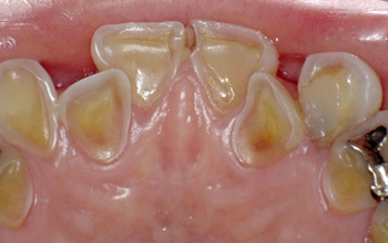 酸蝕歯について 酸蝕歯の治療なら 歯を削らずに治す西村歯科医院 酸蝕歯について 酸蝕歯の治療なら 歯を削らずに治す西村歯科医院