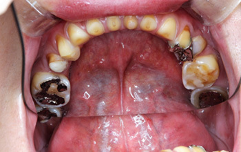 酸蝕歯について 酸蝕歯の治療なら 歯を削らずに治す西村歯科医院 酸蝕歯について 酸蝕歯の治療なら 歯を削らずに治す西村歯科医院