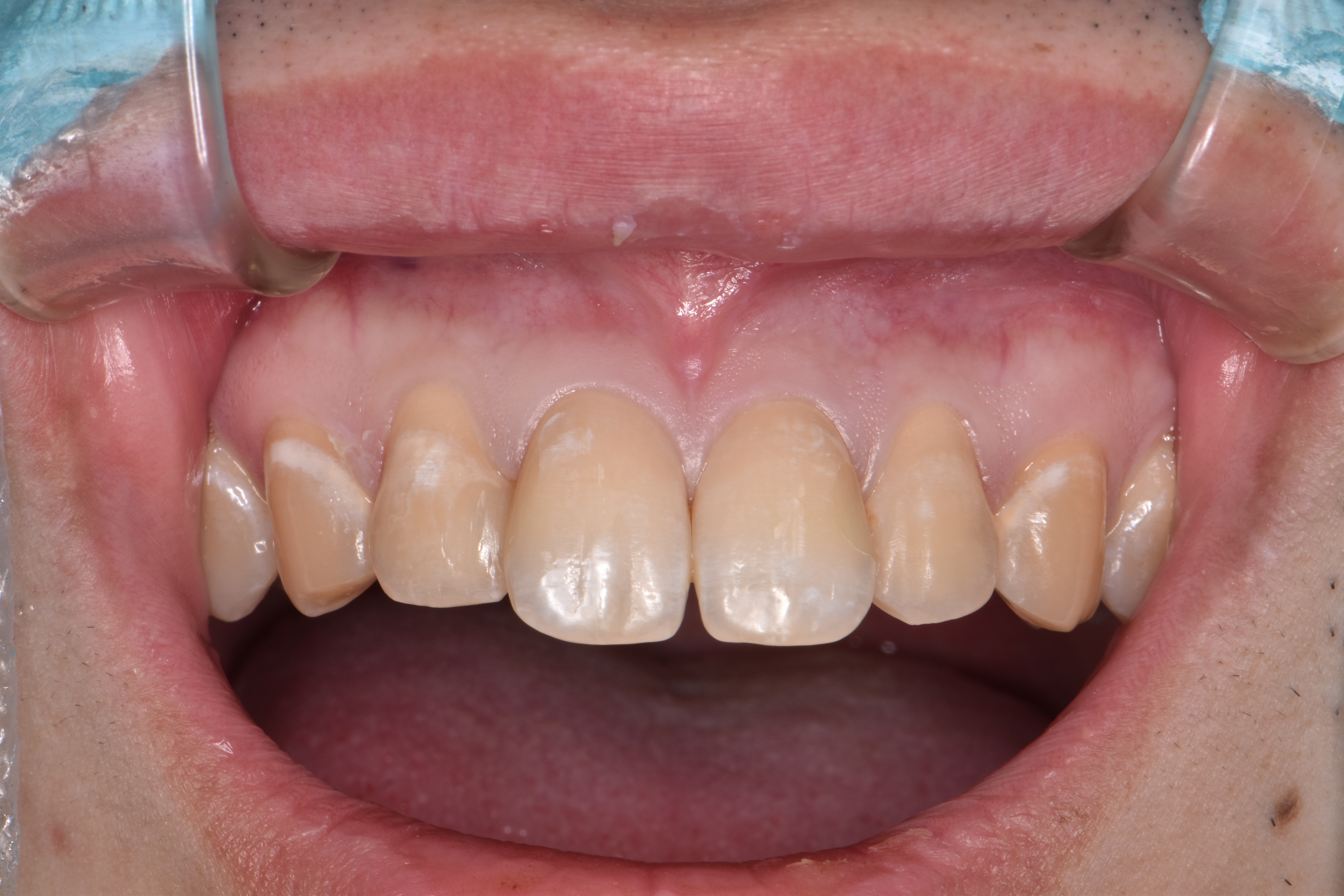 症例集 東京都江東区北砂の砂町北歯科