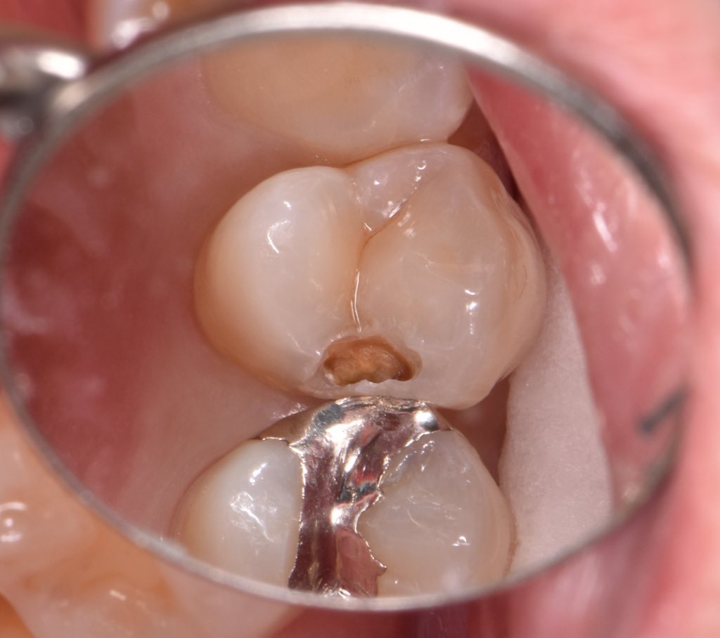 症例集2|東京都江東区北砂の砂町北歯科