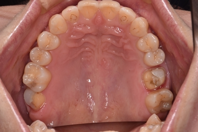 総合治療の症例紹介 砂町北歯科 江東区北砂の砂町銀座商店街の歯医者 総合治療の症例紹介 砂町北歯科 江東区北砂の砂町銀座商店街の歯医者