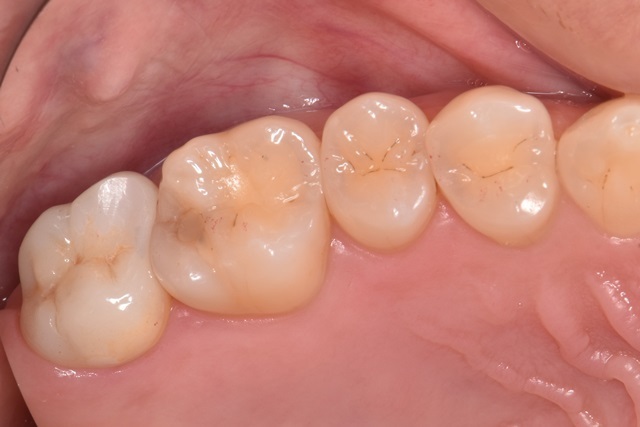 総合治療の症例紹介 砂町北歯科 江東区北砂の砂町銀座商店街の歯医者 総合治療の症例紹介 砂町北歯科 江東区北砂の砂町銀座商店街の歯医者