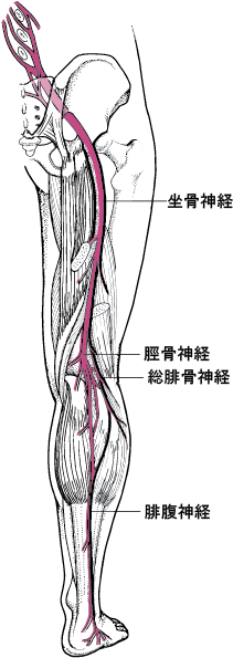 坐骨神経痛