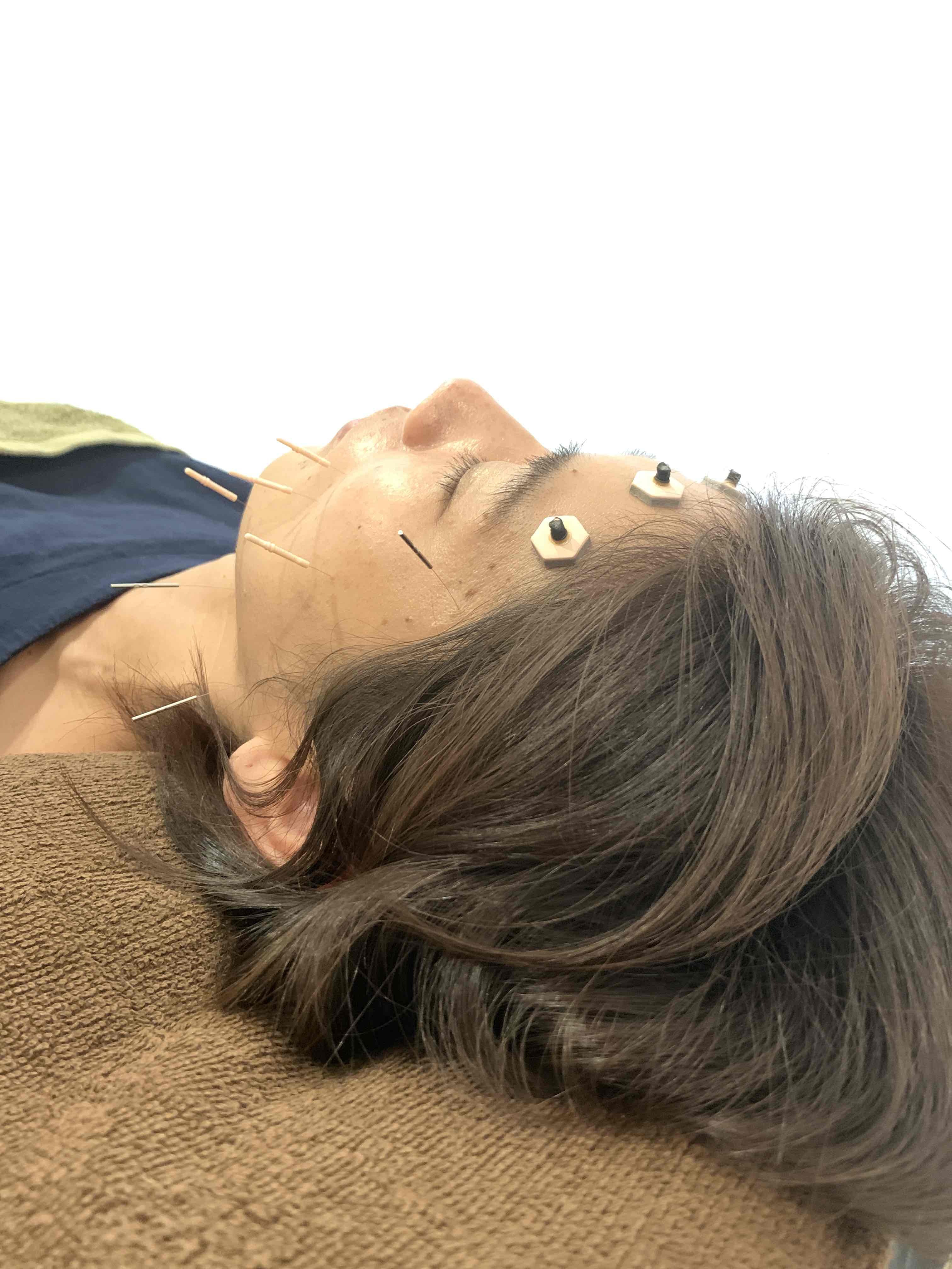 美容鍼①