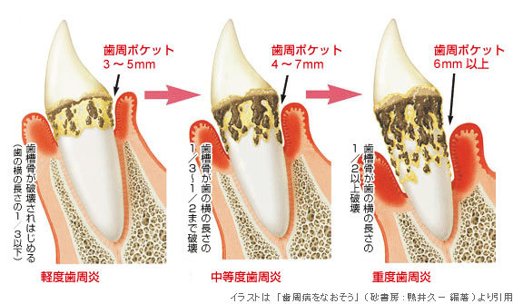 歯周病2