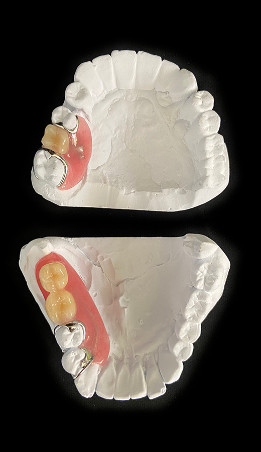 デンチャー|有限会社共栄歯研|福岡の技工所|ラボ デンチャー|有限会社共栄歯研|福岡の技工所|ラボ