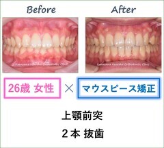 インビザラインで上顎２本抜歯をして出っ歯を改善した26歳女性の治療前後比較