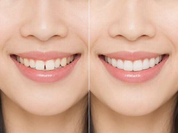 kawaguchi_crystal_shinbi_shika_laminate_veneer_sukippa_before_after