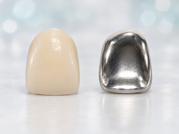 resin-faced-metal-crown-front-back