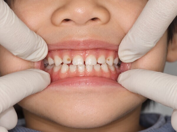 preschool-child-dental-caries