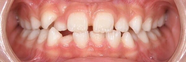 child-malocclusion-crowded-teeth