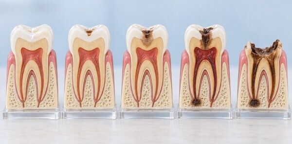 dental-caries-stages-c0-to-c4-model