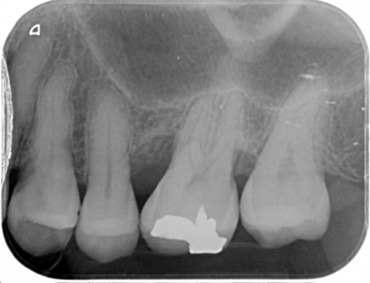 リグロス 術後 デンタル