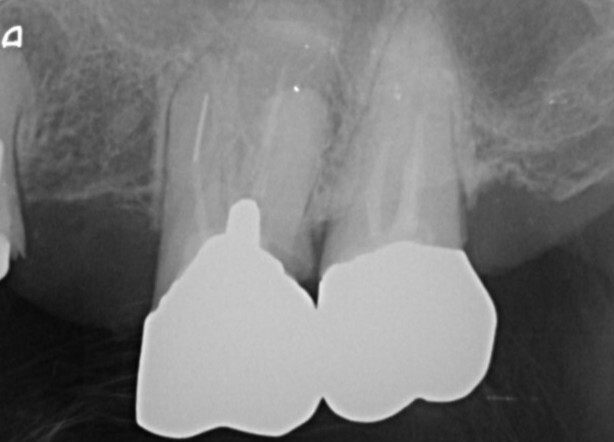 破折ファイル確認 デンタル