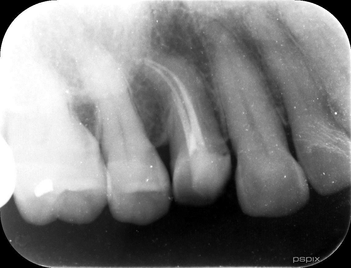 彎曲根管 術後 デンタル