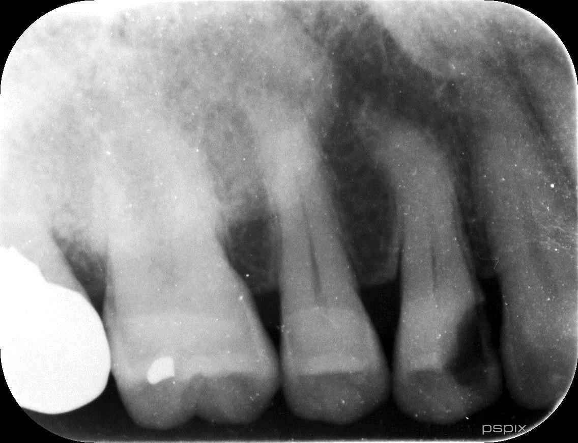 彎曲根管 術前 デンタル