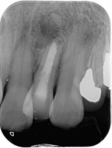 MTAセメント術後5年後 デンタル_コピー_コピー