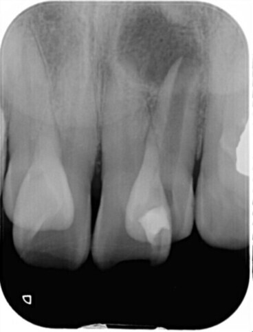 MTAセメント術前 デンタル_コピー_コピー_コピー