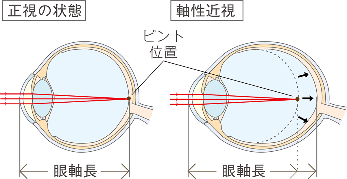 小児近視について なか眼科 芦屋市 阪神打出駅から徒歩1分の眼科専門医