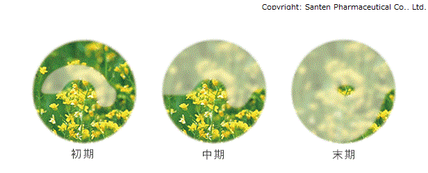 緑内障 ドライアイ なか眼科 芦屋市 阪神打出駅から徒歩1分の眼科専門医