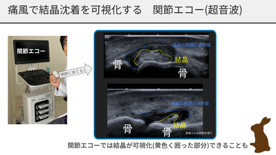 痛風で結晶沈着を可視化する　関節エコー(超音波)長久手クリニック膠原病ブログ用.pptx