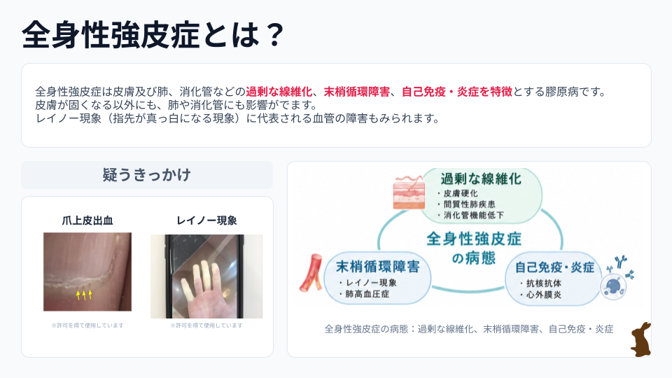 全身性強皮症(SSc) とは？pptx (2)