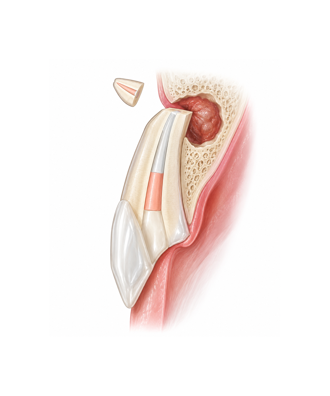 surgical_endodontics