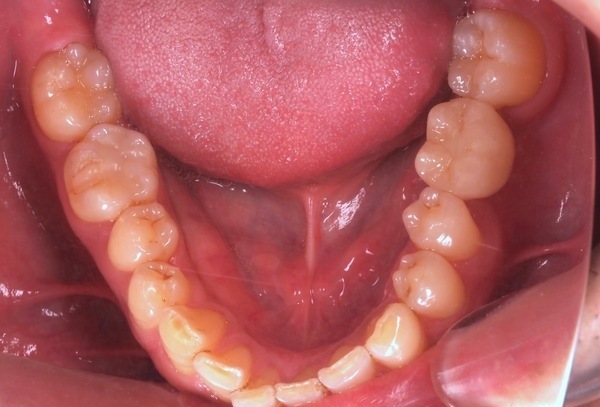 治療例 東池袋駅前デンタルクリニック 池袋 東池袋 治療例 東池袋駅前デンタルクリニック 池袋 東池袋