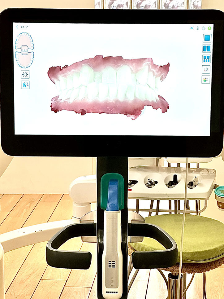 口腔内スキャナー