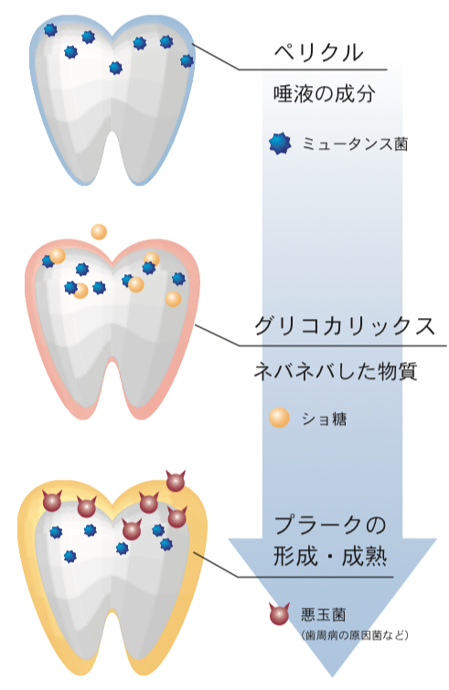 プラークについて|東白楽ハシビロ歯科クリニック|横浜市神奈川区