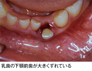 歯がずれた