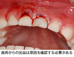 はがぐらぐらする