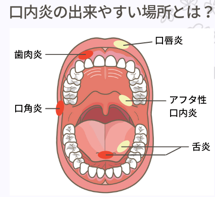 口内炎場所_コピー