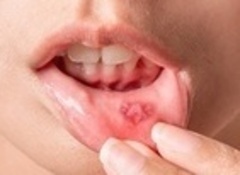 口内炎2_コピー_コピー_コピー