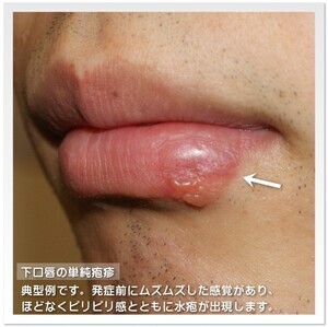 ヘルペス_コピー