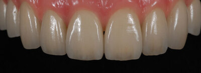 ジルコニアセラミック治療