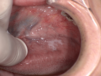 舌にできた白板症