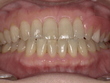 ノンクラスプデンチャー装後　After_コピー
