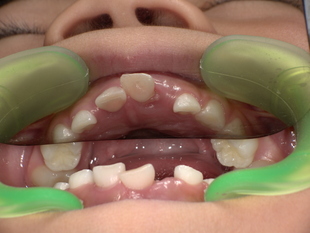 前歯の乳歯抜歯前　Before