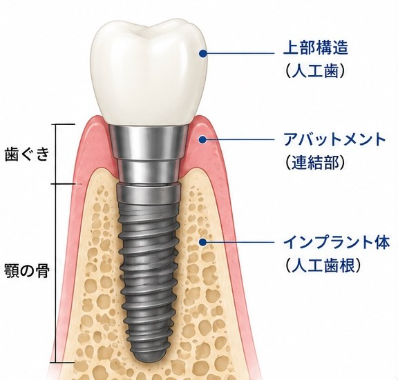 インプラント