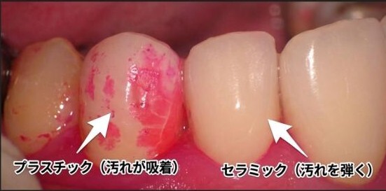 補綴コンサルAI
