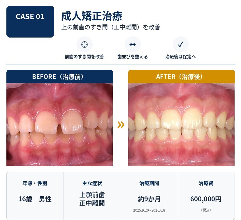 小松歯科医院_CASE01_成人矯正_正中離開z