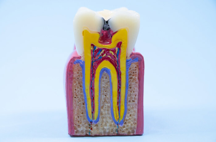 歯髄の近くまで虫歯が進行した状態を表した臼歯断面の模型