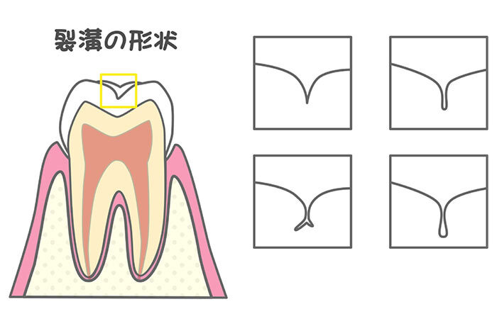 虫歯になりやすい歯の溝（裂溝）の深さや形状の違いを示す解説図